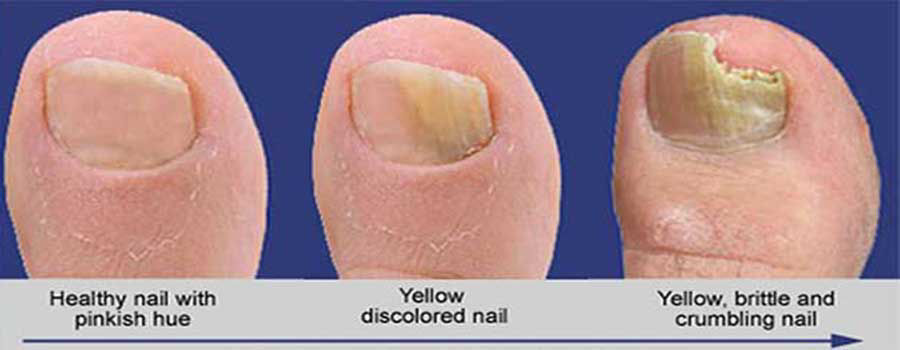 Top 5 Pedicure Infections