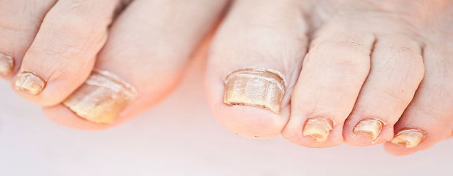 How To Treat Nail Fungus