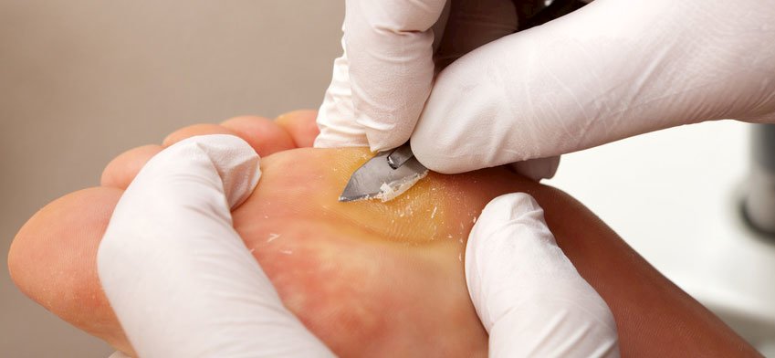 https://tittac.com/images/uploaded/Blogs/How-to-Remove-Calluses.jpg